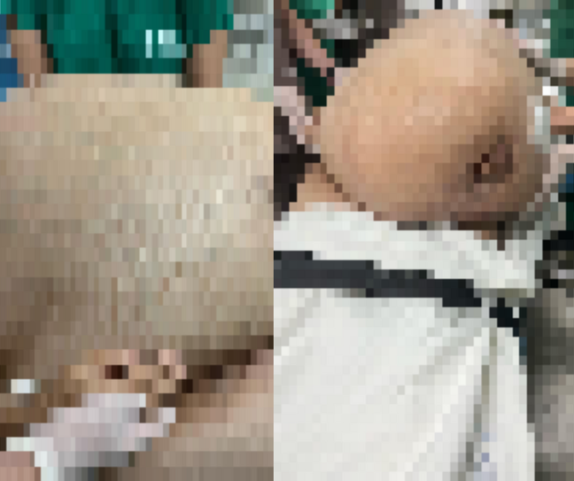 The woman who had a 46 kg tumor removed dies 11 days after surgery