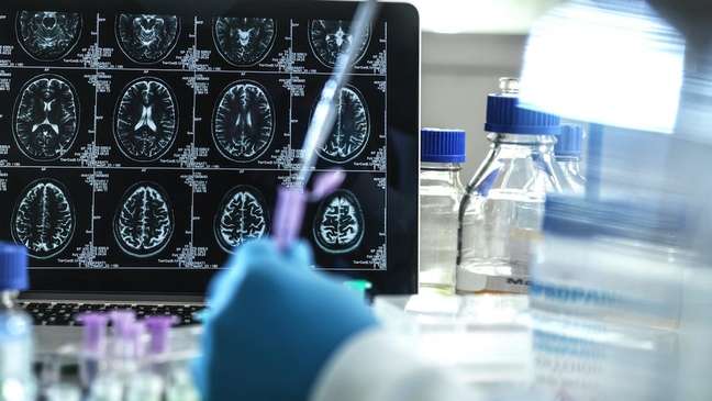 The United States has approved a new drug to combat the underlying causes of Alzheimer's disease The United States has approved a new drug to combat the underlying causes of Alzheimer's disease