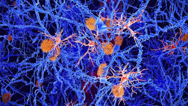 Scientists have identified beta-amyloid (shown in orange) as having harmful effects in Alzheimer's disease