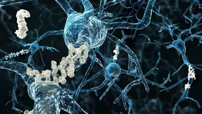 Amyloid plaques are visible in neurons affected by Alzheimer's disease
