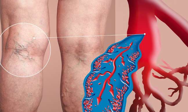 Varicose veins or varicose veins? Know the difference and how to treat them Varicose veins or varicose veins? Know the difference and how to treat them