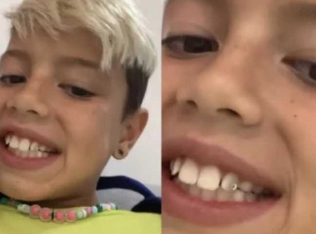 Son of Luana Piovani and Pedro Scooby puts the ‘piercing’ on the tooth.  Know the risks
