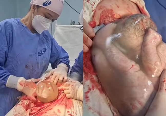 The video shows the birth of twins in which one of the babies is born inside the bag The video shows the birth of twins in which one of the babies is born inside the bag