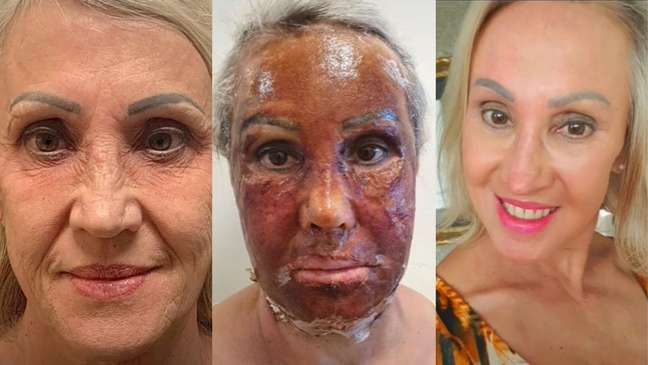Phenol peeling: understanding the advantages and disadvantages of the procedure