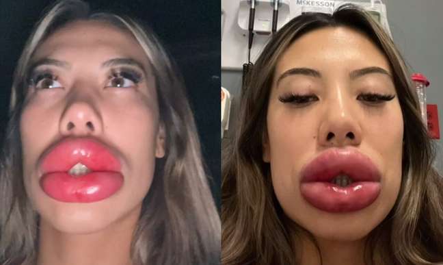 Lip fillers: understand the risks of the procedure Lip fillers: understand the risks of the procedure
