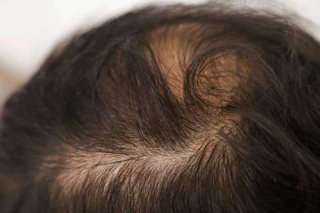 I have a family history of baldness.  What to do to avoid?