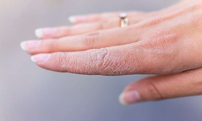 The dermatologist explains what can cause dyshidrosis