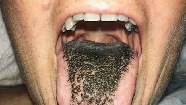 A doença da 'língua peluda'