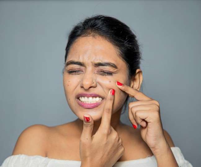 Squeezing pimples can make your skin worse - Squeezing pimples can make your skin worse -