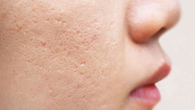 Acne scars: how to prevent and treatment tips