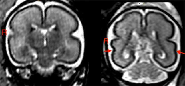 Left, fetal brain after alcohol exposure between 25 and 29 weeks of gestation. Right, fetal brain that hasn't been exposed to alcohol Left, fetal brain after alcohol exposure between 25 and 29 weeks of gestation. Right, fetal brain that hasn't been exposed to alcohol
