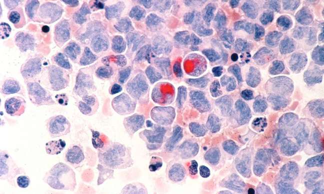 Innovative cancer treatment, CAR-T has its first product on the market and gets new studies in the country