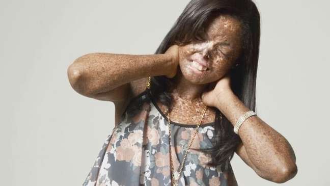 Xeroderma pigmentosum: ‘I change day for night’, says a woman suffering from a rare disease