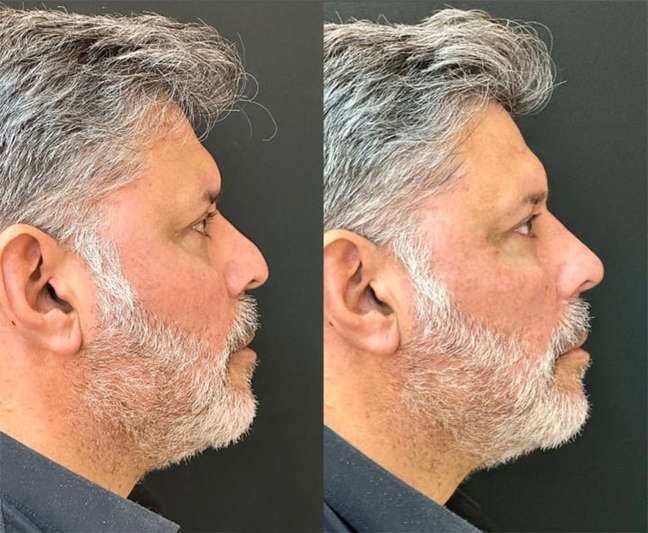 Alexandre Frota performs facial attunement after being declared bankrupt