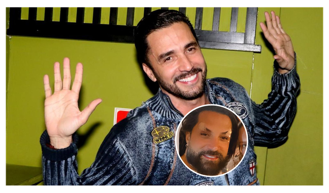 Latino explains unusual appearance after facelift procedure.  See before and after