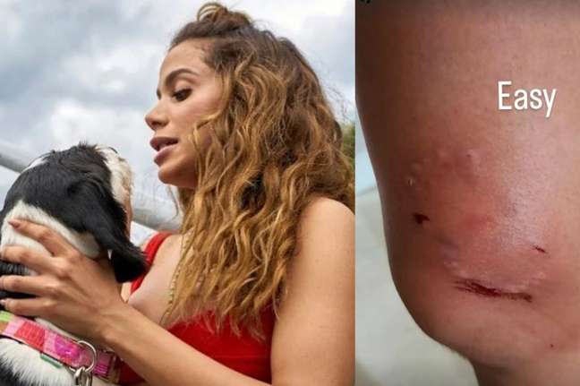 Anitta is bitten when separating dog fights