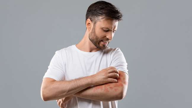 Atopic dermatitis: what are the symptoms and how to treat the condition