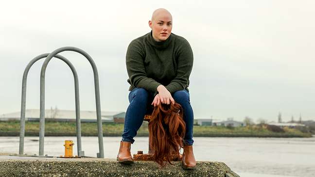 Laura Mathias works in two organisations, as an activist for Changing Faces UK and a volunteer for Alopecia UK. Laura Mathias works in two organisations, as an activist for Changing Faces UK and a volunteer for Alopecia UK.