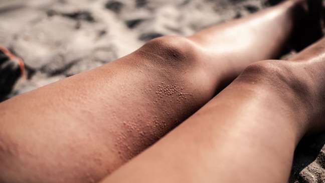 Avoid chafing between your legs this summer with these tips