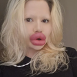 Influencer com os 'maiores lábios do mundo' diz que dentistas se recusam a atendê-la