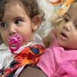 Gêmeas siamesas Kiraz e Aruna passam por cirurgia de separação em Goiânia