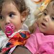 Gêmeas siamesas Kiraz e Aruna passam por cirurgia de separação