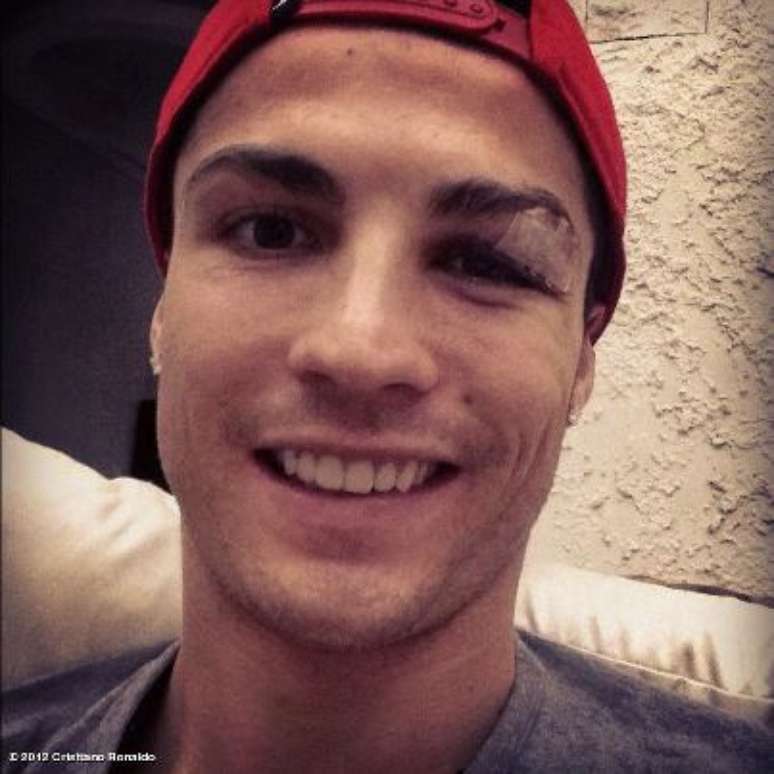 Cristiano Ronaldo postou foto no Facebook após sofrer cotovelada