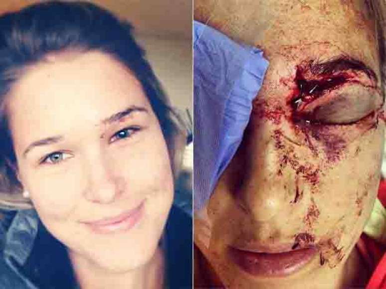 Imagem recente de Morgan Miller (&agrave; esq.) mostra grande recupera&ccedil;&atilde;o ap&oacute;s 50 pontos levados no rosto