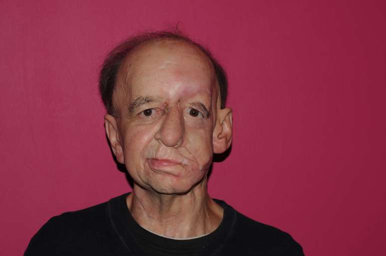 <p>Eric Moger&nbsp;recebeu pr&oacute;tese facial para cobrir depress&atilde;o causada por um tumor maligno</p>