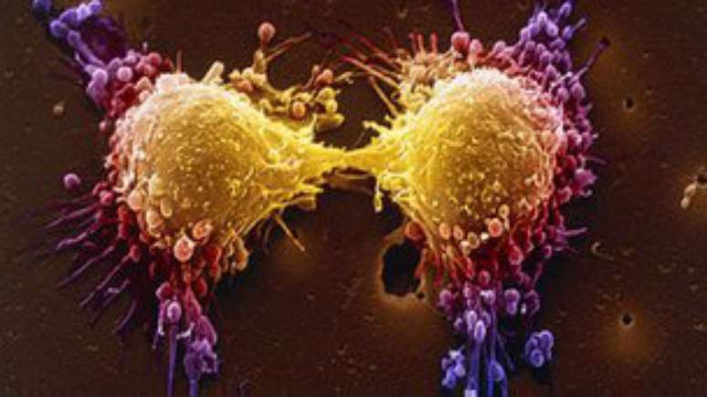 Mutação genética esta ligada à forma agressiva de câncer de próstata
