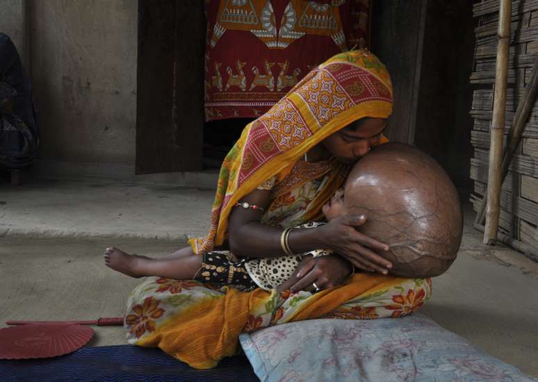 A menina vive no pobre estado de Tripura (nordeste) com seus pais, que não têm condições para internar e tentar uma operação