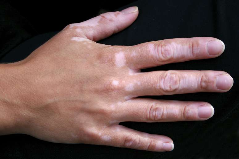 <p>A técnica de repigmentação serve também para tratar o vitiligo</p>