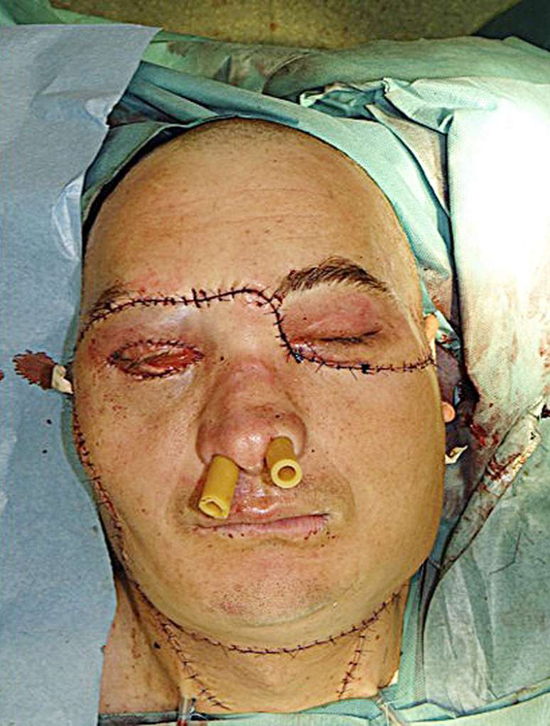 Transplante de rosto foi um dos mais completos realizados