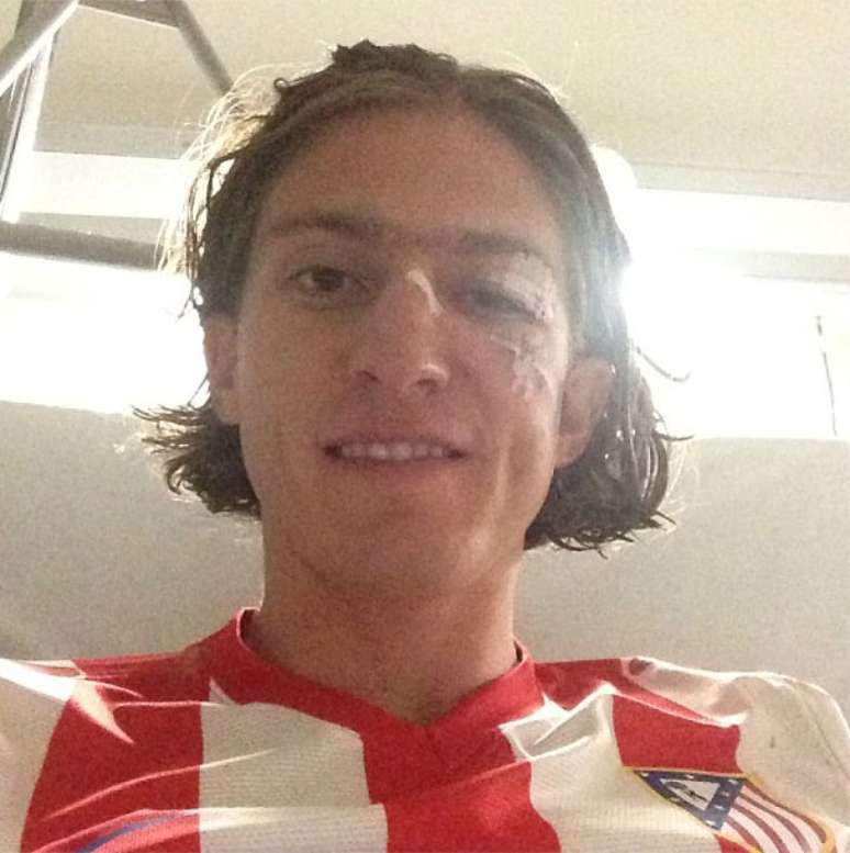 Filipe Luís já exibiu o resultado da pancada e tranquilizou a torcida do Atlético de Madrid