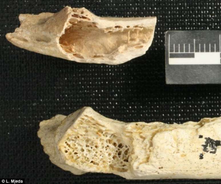 Comparação entre o osso anormal de um neandertal (acima) e o de uma amostra normal (abaixo)