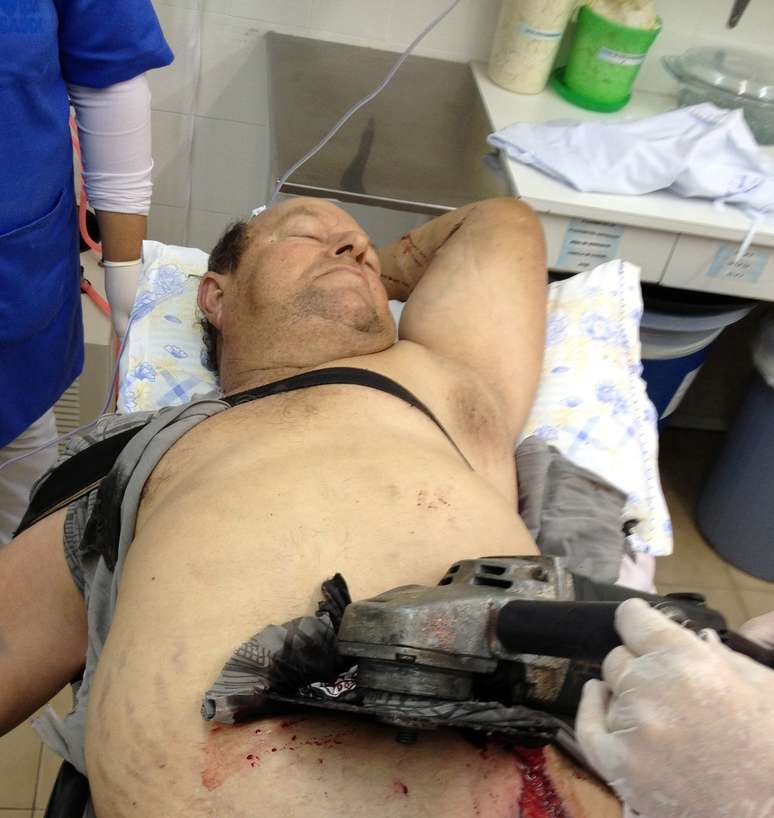 Homem fica com serra presa na barriga após se ferir durante corte de madeira