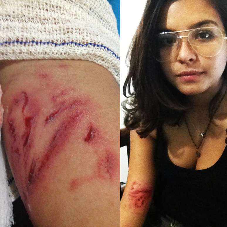 Estudante postou foto com marcas da agressão sofrida durante o protesto