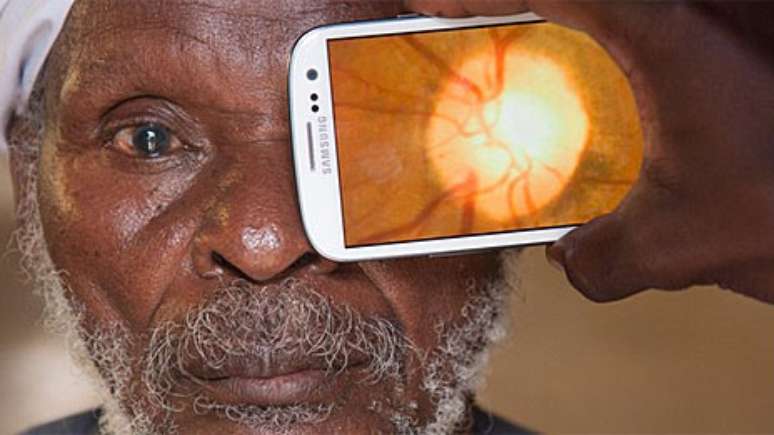 <p>Aplicativo usa a câmera do celular para examinar os olhos e detectar a catarata</p>