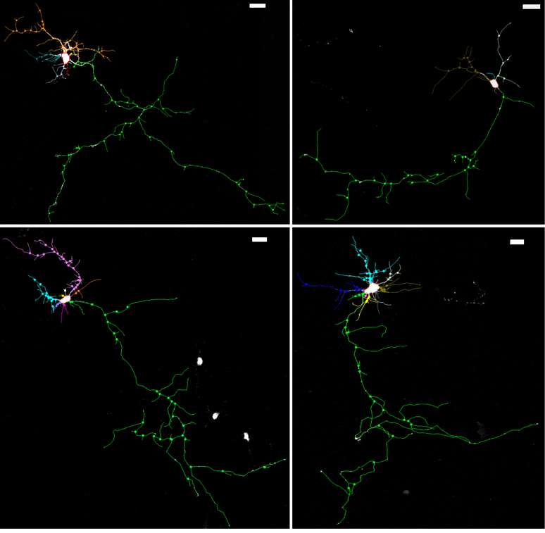 Imagem mostra no topo à esquerda um neurônio normal. À direita deste, está um neurônio de um camundongo com mutação no gene que produz a proteína NHE6. Na parte inferior, à esquerda, aparece novamente um neurônio normal e, à direita, um com defeito - mas ambos tendo recebido tratamento com BDNF