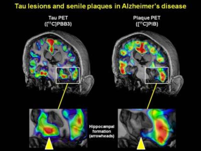 <p>Exame mostra a acumulação de proteína tau e de beta-amiloide em um cérebro de paciente com Alzheimer. As flechas indicam a região hipocampal, ligada à memória</p>