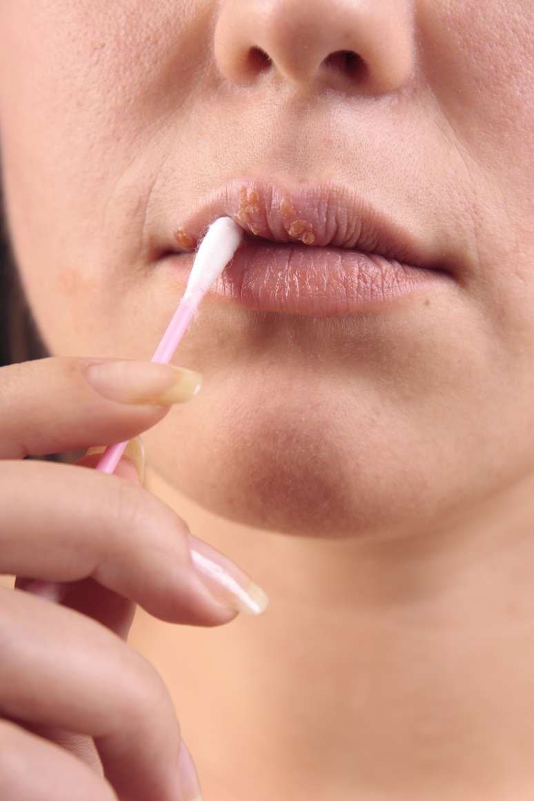 Herpes labial que no cura podría ser signo de cáncer bucal