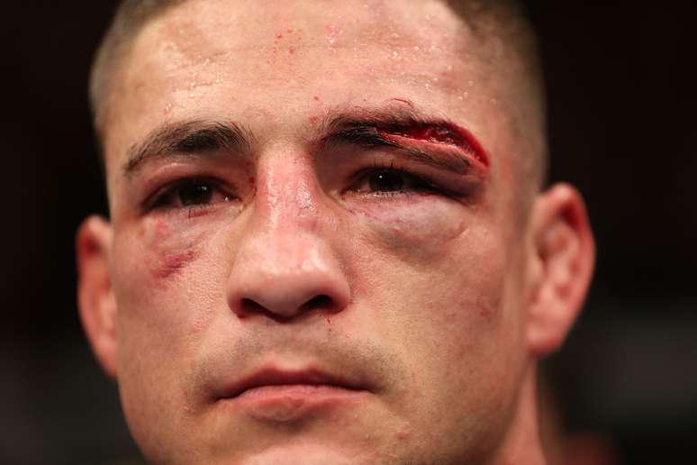 Diego Sanchez exibe corte no supercílio obtido na derrota para Gilbert Melendez em emocionante luta pelo UFC 166