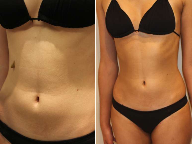 <p>A pedido do&nbsp;<strong>Terra</strong>, Sophie aplicou a t&eacute;cnica na jovem modelo Mariani Soares Iori, da Oca Models. Aqui, montagem&nbsp;mostra&nbsp;detalhes do antes e depois do bronzeamento. Confira passo a passo de autobronzeamento a seguir</p>