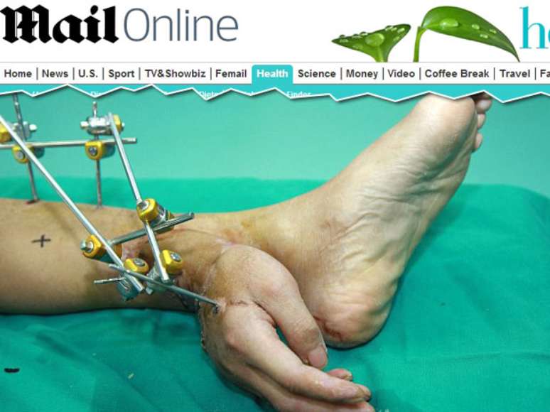 <p>Na China, médicos implantaram a mão de um paciente na perna para reimplantá-la no local certo um mês depois.</p>