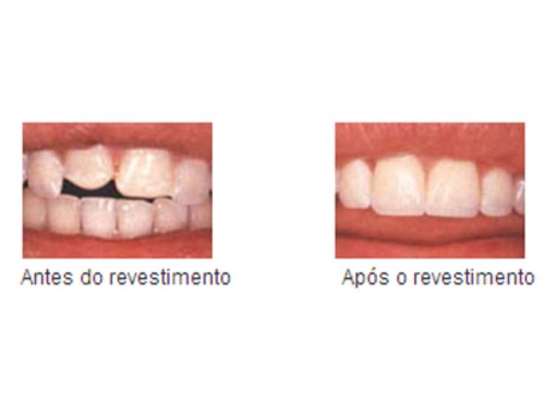 Antes do revestimento