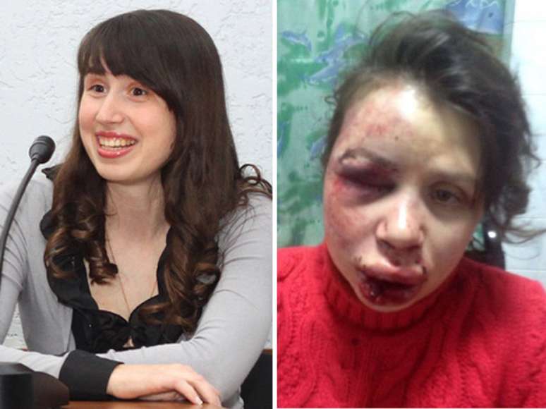 Rosto de Tetiana Chernovil ficou desconfigurado após agressão