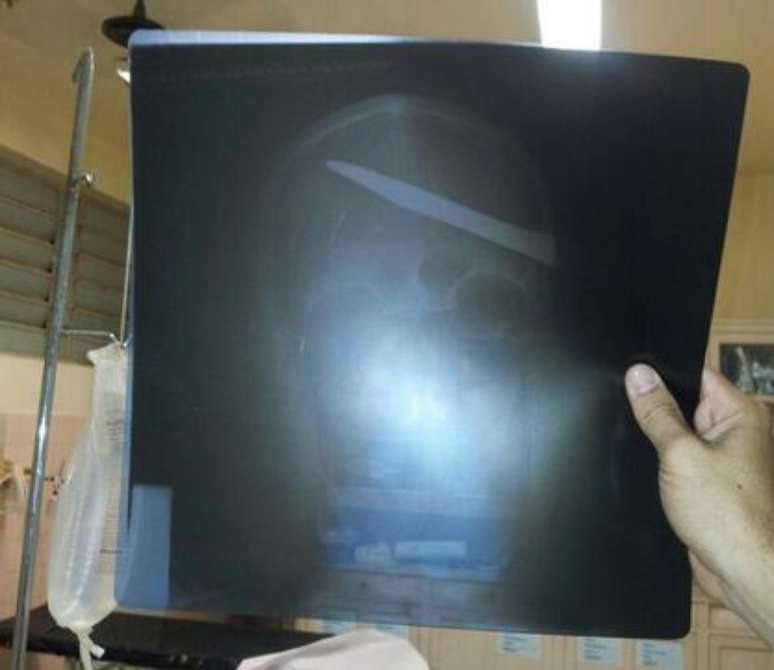 Radiografia mostra como a faca penetrou na cabeça do paciente