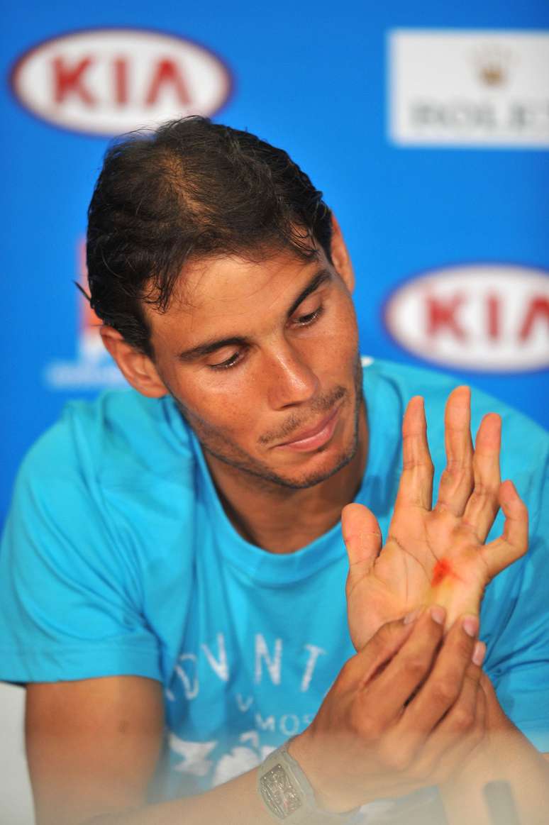 <p>Nadal mostra bolha que formou em sua mão durante entrevista</p>