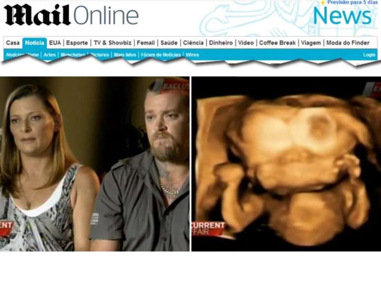 <p>O nosso bebê tem dois cérebros e dois rostos, mas ainda assim nós o queremos, declararam os pais do feto australiano ao canal de TV Current Affair</p>