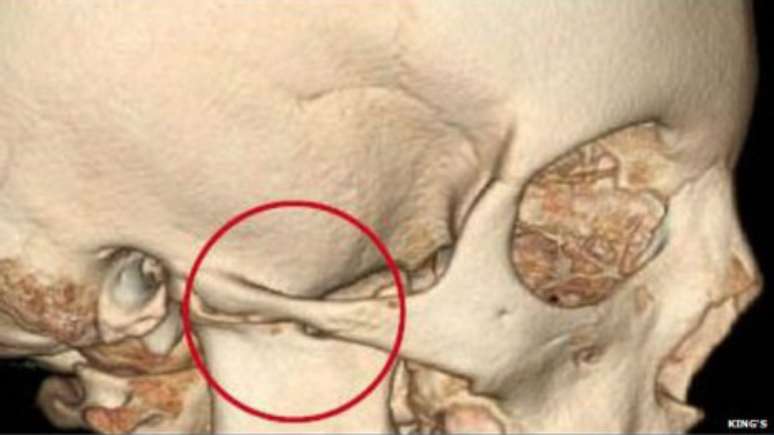 Parte da articulação foi removida na operação de modo que a mandíbula ficou conectada ao crânio apenas por músculo e ligamentos no lado direito